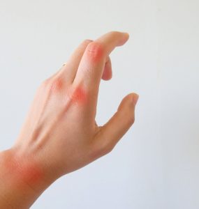 Hand showing joint pain associated with arthritis