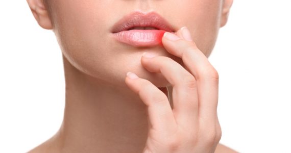 Woman with cold sore touching lips