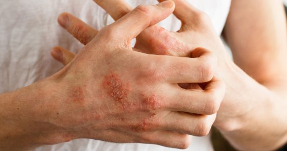 Close up of hands with eczema itching