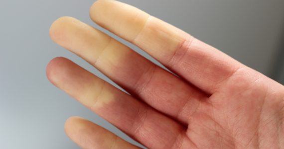 CLose up of hand showing someone suffering from Raynaud's disease