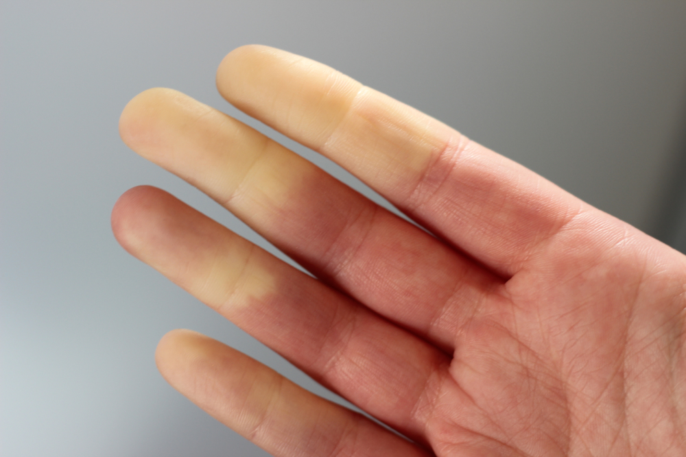 Relief for Raynaud's: top tips for managing your symptoms