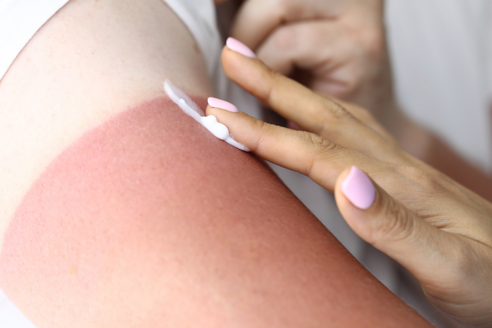 Close up of someone applying sun burn relief cream