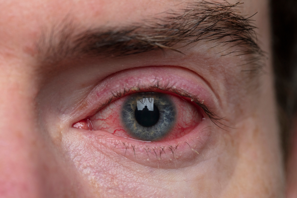 Blepharitis in the eye