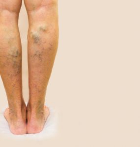 Close up of woman's legs showing varicose veins