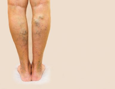 Close up of woman's legs showing varicose veins