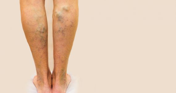 Close up of woman's legs showing varicose veins