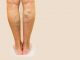 Close up of woman's legs showing varicose veins