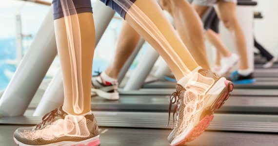 Close up of woman's legs on treadmill showing the bone outlines