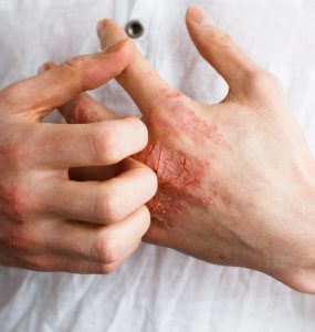 Close up of hands showing eczema