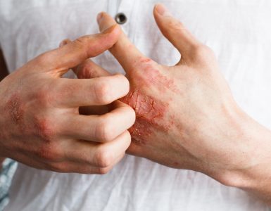 Close up of hands showing eczema