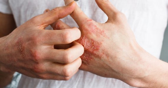 Close up of hands showing eczema